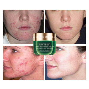 BREYLEE cara de árbol de té anti acné y punto negro de epiderm <span class=keywords><strong>Crema</strong></span> para el acné - Product Image 4