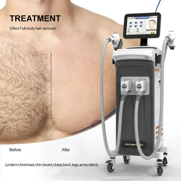 Nubway newest Professional Ice Laser Hair Removal 755 808 1064 diode laser hair removal machine