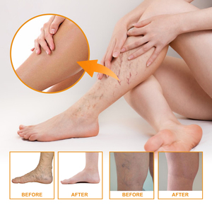 EELHOE Vitamin K <strong>Cream</strong> Glycerin <strong>Varicose</strong> <strong>Veins</strong> Spider <strong>Veins</strong> Bruising Redness Soothing Massage OEM Private Label Wholesale Bulk - Product Image 3