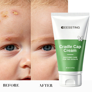 Crema Reparadora OEM/ODM, Fórmula Suave No Irritante, Elimina las Escamas, Alivio Seguro para el Cuidado Diario del Cuerpo de Recién Nacidos, Crema para la Capilaria - Product Image 2