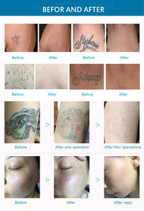 Máquina de Eliminación de Tatuajes Pico <span class=keywords><strong>Taibo</strong></span> 2026 Nueva 755 1064 para Pigmentación, Pecas, Manchas de la Edad, Eliminación de Cejas, Cepillo de Limpieza Facial Pico - Product Image 6