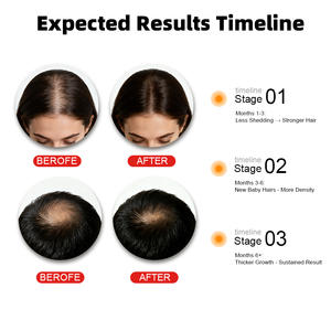 หมวกบำบัดแสงสีแดง850nm 660nm ไร้สาย OEM ODM หมวกรักษาด้วยแสงสีแดงเจริญเติบโตแบบไร้สาย - Product Image 5