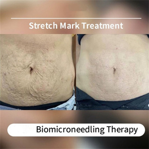 Salon Custom ized/Private Logo Verfügbar Spong illa Spicules Haut Peeling Akne Pigmentierung Massage Verwenden Sie natürliche nicht chemische Säure - Product Image 5