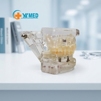 Modelo de Resina Desmontable para Implantes Dentales y Dientes Patológicos, Demostración de Cuidado Bucal y Puentes y Coronas de PVC para Ciencia Médica CE
