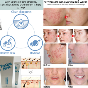 Soin de la peau en marque privée, gel réparateur anti-acné, élimination des boutons, soin de la peau à base d'herbes à l'arbre à thé, traitement de l'acné pour tous les types de peau - Product Image 5