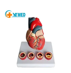 Медицинская обучающая модель сердечной патологии, модель коронарной атеросклеротической болезни сердца