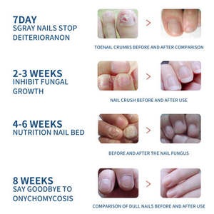 Patch de soin des ongles EELHOE pour les ongles gris, doux, incrustés et épaissis - Product Image 4