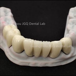 พอร์ซเลนหลอมรวมกับฟันปลอมโลหะ (โลหะผสมโครเมี่ยมโคบอลต์) - Product Image 6