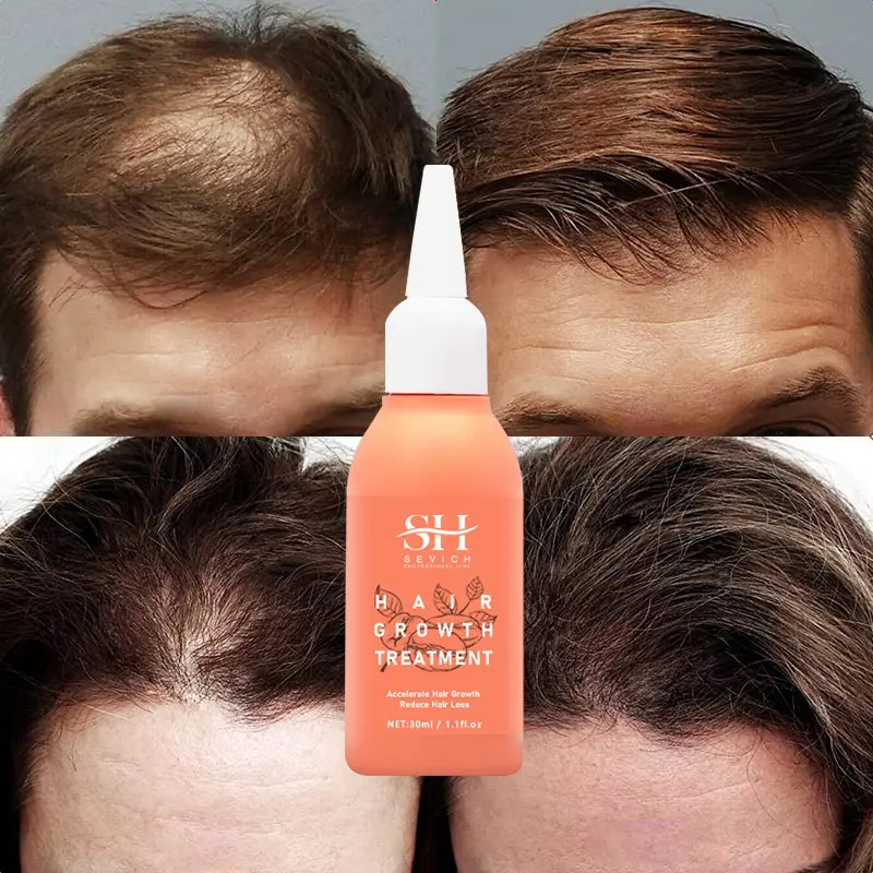 OEM الشعار الخاص Microneedling الكافيين زيت إنبات الشعر السريرية الصف الخلايا الجذعية الشعر نمو المصل
