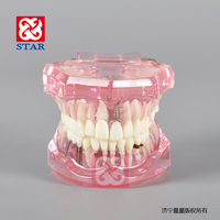 Puente de restauración de dientes extraíbles estándar, modelo Dental, enfermedad de implante, modelo Typodont para dentista que estudia ciencias médicas