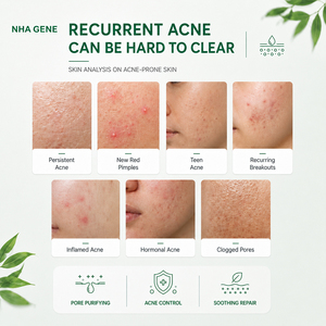 Crème anti-acné à l'acide salicylique en marque blanche, traitement BHA, contrô<span class=keywords><strong>le</strong></span> des pores, élimination des points noirs, équilibre du sébum, acide azélaïque, purification de la peau - Product Image 2