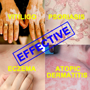 Equipo de Dermatología Kernel, Lámpara UVB UVA para Fototerapia Médica, Lámpara UVB de Cuerpo Completo para el <span class=keywords><strong>Tratamiento</strong></span> del Vitiligo y la Psoriasis - Product Image 6