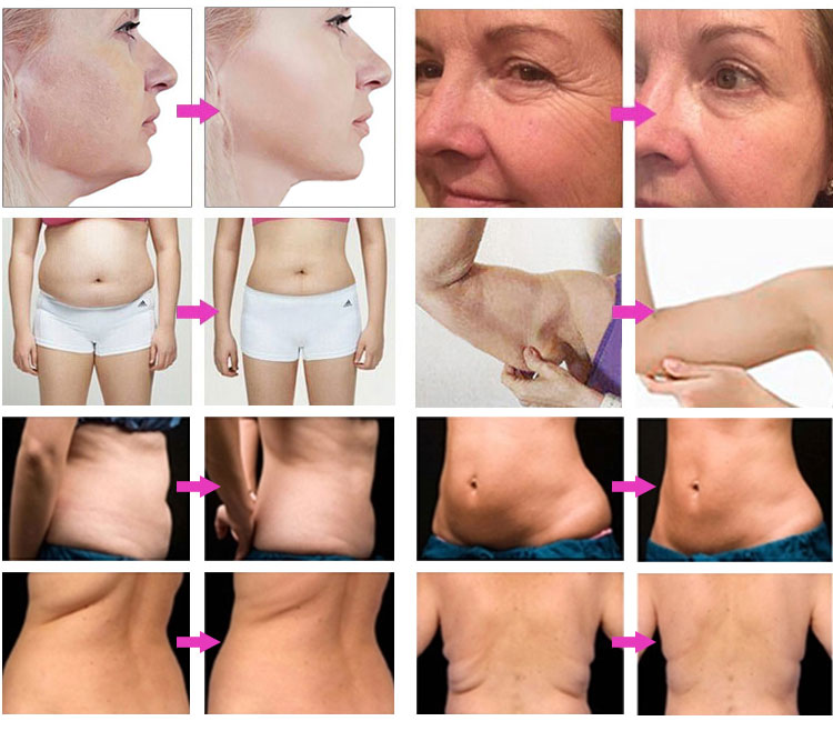 V-max Hifu Anti-wrinkle Machine 7D Hifu Face Lifting Beauty Device