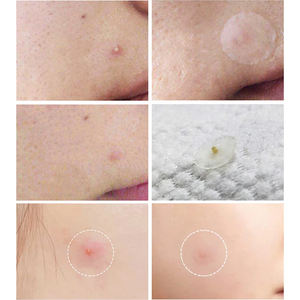 Patch anti-acné transparent à l'huile d'arbre à thé personnalisé, patch anti-acné hydrocolloïde imperméable pour couvrir l'acné - Product Image 4