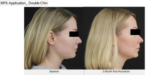 Appareil de raffermissement cutané du <span class=keywords><strong>visage</strong></span> et du corps par ultrasons focalisés de haute intensité 7D, <span class=keywords><strong>laser</strong></span> Hiifu, élimination des rides, 7 cartouches, machine d'élimination de la graisse - Product Image 4