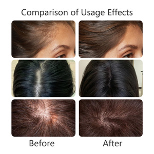 Suero Roll-On Anticaída con <span class=keywords><strong>Areca</strong></span> <span class=keywords><strong>Catechu</strong></span>, Romero y Lytta Vesicatoria para Reparación del Cuero Cabelludo, Fortalecimiento de Raíces y Tratamiento para el Crecimiento del Cabello - Product Image 4