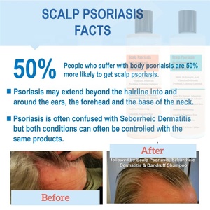 Shampooing et revitalisant pour le cuir chevelu, <span class=keywords><strong>psoriasis</strong></span>, pellicules, dermatite séborrhéique, peau irritée, pelliculaire et enflammée, <span class=keywords><strong>apaisant</strong></span>, hydratant, soulagement - Product Image 3
