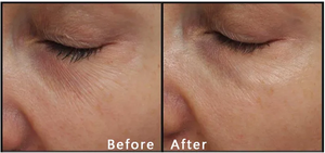 Nano Tinysoft 0.6mm 0.8mm 1.0mm 1.2mm 1.5mm Film per Microneedling con Aghi a 3 Punte per Ringiovanimento della Pelle e Sopracciglia - Product Image 4