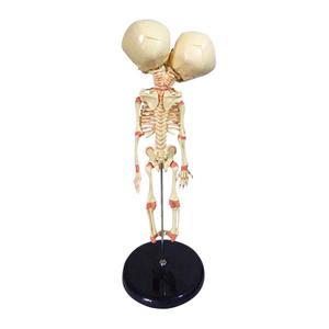 Foetale Twee Koppige Misvorming Model Schedel Medische Wetenschap Baby Skeletmodel Leert Menselijk Botmodel Abnormaal - Product Image 6