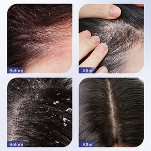 MOOYAM Professional Acne-fighting Oil-removing Shampoo <strong>Moisturising</strong> and Repairing Hair Texture Shampoo - Product Image 5