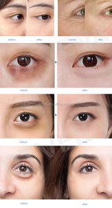 Crema para Ojos OTVENA - 100% Efectiva contra la Hinchazón y las <span class=keywords><strong>Ojeras</strong></span>, Reafirma la Piel del Contorno de Ojos en 60 Segundos - Product Image 2