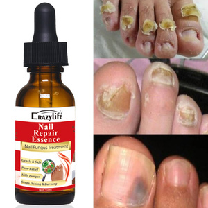 10ml efficace riparazione delle unghie siero essenze Anti fungo rimuovere onicomicosi punta nutriente Logo personalizzato pronto per la spedizione - Product Image 2