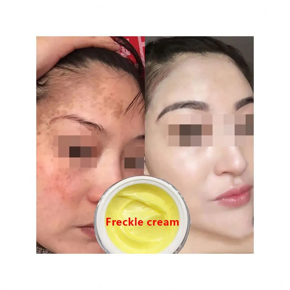 Made In China Leistungs starke White ning Sommersprossen creme Kräuterpflanzen-Gesichts creme Entfernen Sie Sommersprossen und dunkle Flecken Haut aufhellung creme