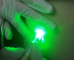 Láser de Diodo de 532 nm para Máquina Portátil de Eliminación de <span class=keywords><strong>Arañas</strong></span> <span class=keywords><strong>Vasculares</strong></span> - Product Image 4