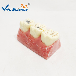 แบบจำลองสาธิตฟันผุ; สื่อการสอนเพื่อการเผยแพร่และแสดงผลทางวิทยาศาสตร์ด้านสุขภาพช่องปากและพยาธิวิทยา; การสอนทางปาก - Product Image 4