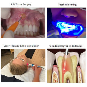 <span class=keywords><strong>Laser</strong></span> <span class=keywords><strong>Dental</strong></span> Portátil de Diodo Azul 450nm 650nm 980nm Equipamento <span class=keywords><strong>Dental</strong></span> Certificado <span class=keywords><strong>CE</strong></span> para Cirurgia de Tecidos Moles - Product Image 6