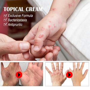 South Moon Sweat Blister Crème anti-démangeaisons pour peau sèche contre les piqûres de moustiques - Product Image 2