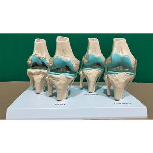 Fabrieks Menselijk Skelet Anatomisch Bot Leermodel 4-Stage Zieke Kniegewrichtsmodel - Product Image 4