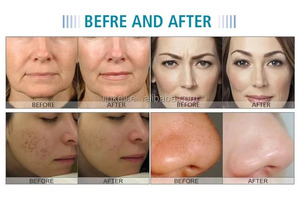 Equipo de Belleza de Escritorio <span class=keywords><strong>con</strong></span> Tecnología de Enfriamiento para <span class=keywords><strong>Eliminar</strong></span> Lunares, <span class=keywords><strong>Verrugas</strong></span>, Pecas, Marcas de Acné y Manchas, Restaura la Piel - Product Image 6