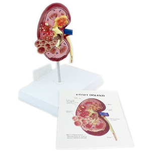 Modelo Anatómico de Riñón con Quiste Renal, Modelo de Anatomía Humana para Enseñanza Médica, Equipo de Patología Renal para Modelo de Quiste Renal - Product Image 5