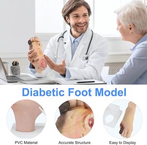Modelo de pie diabético (leve/severo) para formación médica, maniquí preventivo para el pie diabético, silicona CE/ISO - Product Image 2