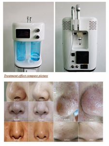 Máquina de Hidrofacial de Nuevo Modelo, Chorro de Oxígeno, Dermoabrasión, Equipo de Belleza Profesional para Salón de Belleza y Spa, Rejuvenecimiento de la Piel, Limpieza Profunda - Product Image 3