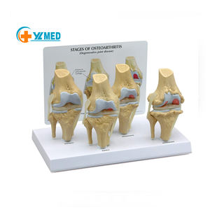 Modèle d'articulation du genou en science médicale, ensemble d'arthrose à 4 étapes, articulation du genou pour le bureau des médecins, outil éducatif - Product Image 1