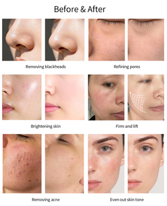 Appareil facial multifonction à jet d'oxygène Reskin DM-525C1 avec écran tactile pour le rajeunissement de la peau et le nettoyage en profondeur - Product Image 6
