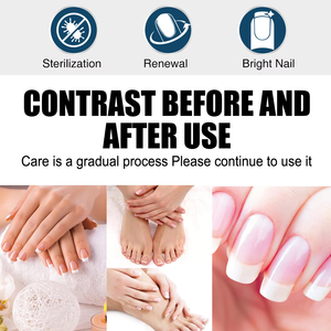 South Moon Aceite Esencial para <span class=keywords><strong>Hongos</strong></span> <span class=keywords><strong>en</strong></span> las Uñas, Onicomicosis, Paroniquia, Aclaramiento de Uñas de los Pies, Cuidado de los Pies - Product Image 6
