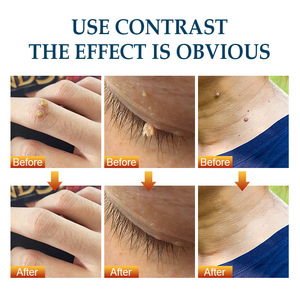 <span class=keywords><strong>Crema</strong></span> de Tratamiento <span class=keywords><strong>para</strong></span> <span class=keywords><strong>Verrugas</strong></span> <span class=keywords><strong>Genitales</strong></span> 100% Natural a Base de Hierbas con Vitamina E <span class=keywords><strong>para</strong></span> la Eliminación de <span class=keywords><strong>Verrugas</strong></span> <span class=keywords><strong>Genitales</strong></span> - Product Image 3