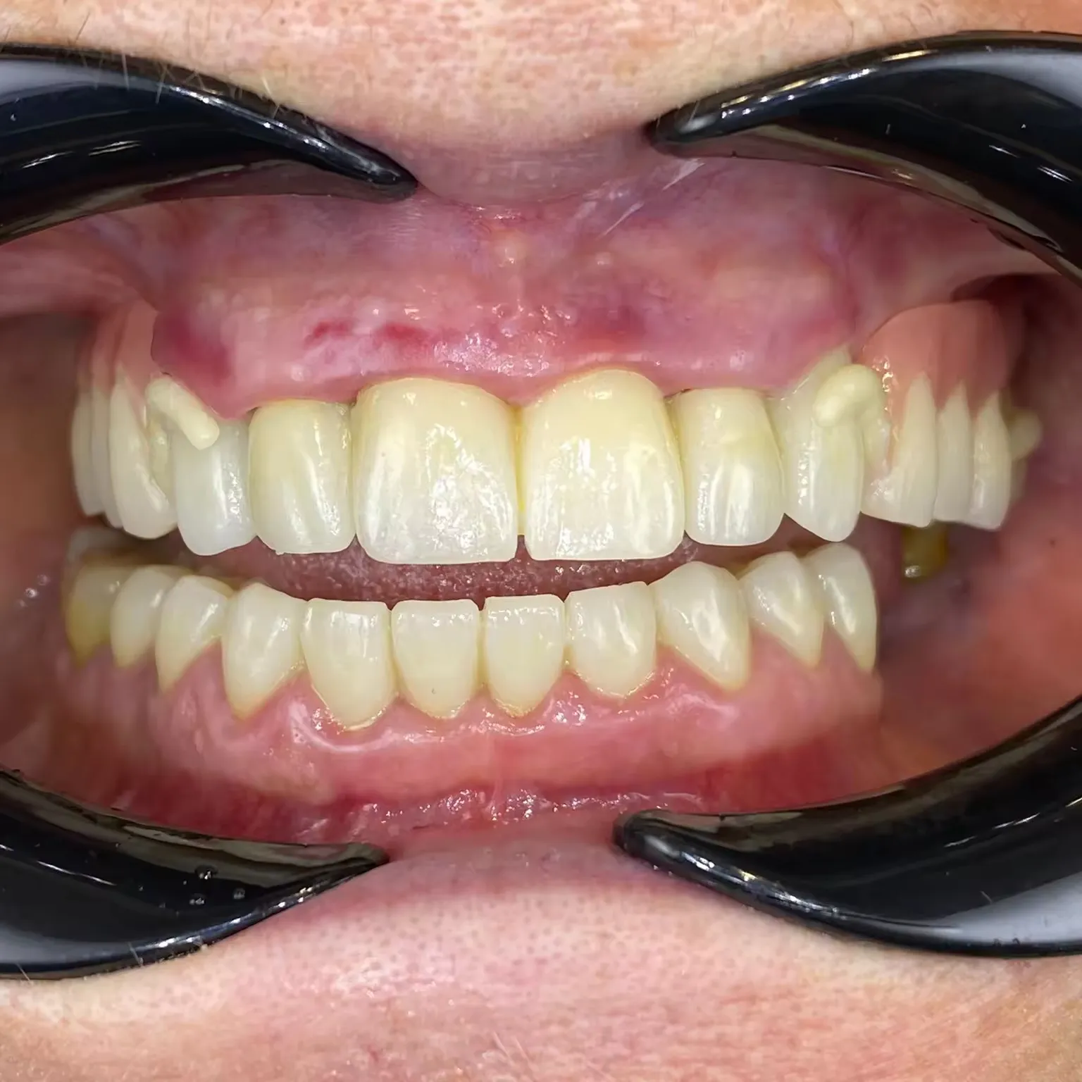 Yucera bloques de zirconia dental de alta calidad 3D más multicapas 6 capas de color multicapa para laboratorio dental clínica dental