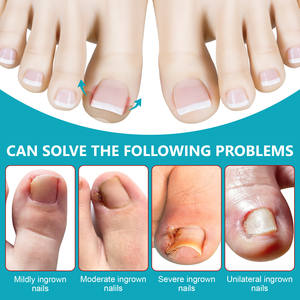 Parches para el Tratamiento de Uñas Encarnadas SEFUDUN al por Mayor, Kit de 120 Tiras Correctoras para Uñas Encarnadas con Lima y Levantador - Product Image 3
