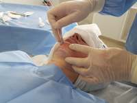 Serat Fiber Sekali Pakai 25cm Khusus untuk Wajah Endolift Laser, Satu Serat untuk Satu Pasien