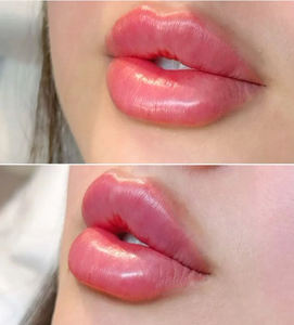 Prix d'usine Hadurage Red Lips <span class=keywords><strong>1</strong></span>*2ml HA Enriched Lip Dermal Filler, <span class=keywords><strong>seringue</strong></span> préremplie stérile pour des lèvres rouges et plus pulpeuses - Product Image 5