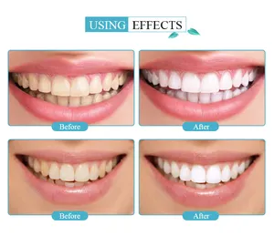 Private Logo Salon Dental Bleaching Cold Blue Led Light Teeth Whitening Device Kit Cheap Wholesale