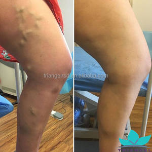 Endoveneuze Laserablatie Spataderen Apparaat 980nm + 1470Nm Diode Laserbehandeling Benen Spataderen - Product Image 3