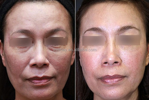 핫 세일 휴대용 스파 살롱 클리닉 사용 바늘 메조 테라피 장치 피부 강화 Electroporation 메조 테라피 기계 - Product Image 4