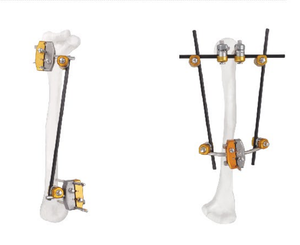 <span class=keywords><strong>Fixator</strong></span> eksternal ortopedi operasi ortopedi gabungan batang <span class=keywords><strong>Fixator</strong></span> eksternal dan koneksi penjepit Pin - Product Image 3