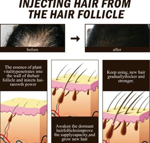 Sérum de <span class=keywords><strong>repousse</strong></span> des cheveux EGF Sérum de perte de cheveux Ampoule Réparation des dommages/ODM Sérum de croissance des cheveux w - Product Image 5