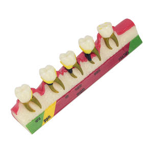 Modelo Anatómico de Periodoncia Oral para Gingivitis, Periodonitis Crónica, Clasificación de Grado, Comunicación Dental - Product Image 4